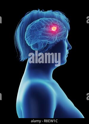 Abbildung: ein Tumor im Gehirn der Frau. Stockfoto