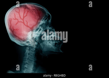 X-ray Image mit rot Höhe Licht mit der Durchblutung im Gehirn Stockfoto