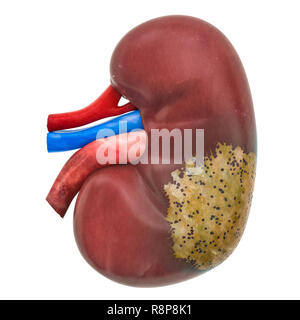 Nierenerkrankungen Konzept, 3D-Rendering auf weißem Hintergrund Stockfoto