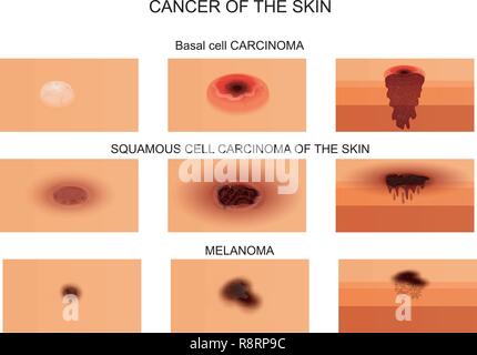 Vector Illustration von Hautkrebs. bereits in der ersten Phase und in der Phase der Nekrose. der Schnitt. Stock Vektor