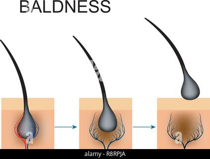 Vector Illustration von Durchblutungsstörungen im Haarfollikel. Kahlheit Stock Vektor