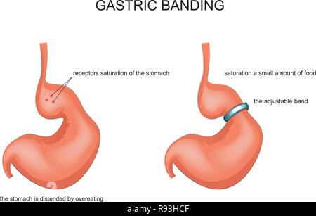 Vector Illustration von Gastric Banding, von Überessen gestreckt Stock Vektor