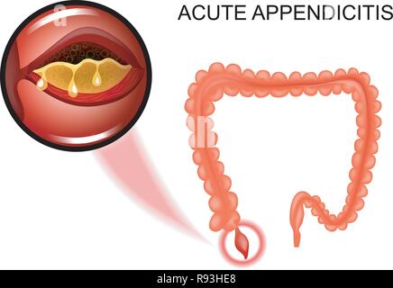 Vector Illustration einer akuten Blinddarmentzündung, die Entzündung der Anlage Stock Vektor