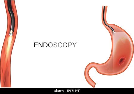 Vector Illustration einer Endoskopie des Magens. EGD. Geschwür, Krebs Stock Vektor