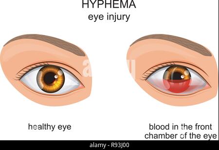 Vector Illustration der Auge Verletzung des Auges. hyphema. Stock Vektor
