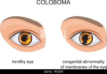 Vector Illustration der angeborene Störung der Membranen des Auges. coloboma Stock Vektor