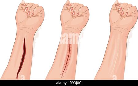 Vector Abbildung: genähte Wunde Hände. Chirurgie Stock Vektor