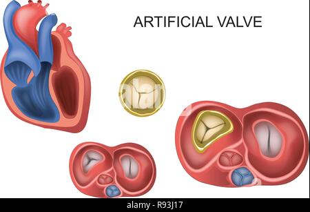 Vector Illustration einer prothetischen Trikuspidalklappe Herzklappe Stock Vektor