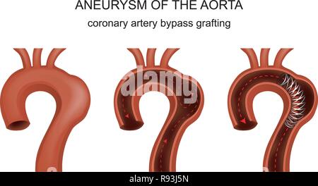 Vector Illustration zu einer aortokoronaren Bypass Stock Vektor