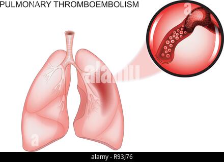 Vector Illustration der pulmonalen Thromboembolien. Thrombose des Schiffes Stock Vektor