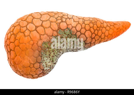 Bauchspeicheldrüsen Erkrankung Konzept, 3D-Rendering auf weißem Hintergrund Stockfoto