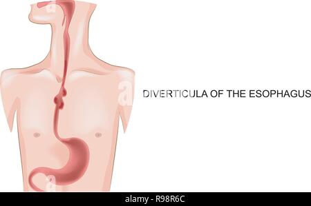 Vector Illustration der divertikel der Speiseröhre Stock Vektor