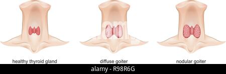 Vector Illustration der Kropf, Schilddrüse Endokrinologie. Stock Vektor