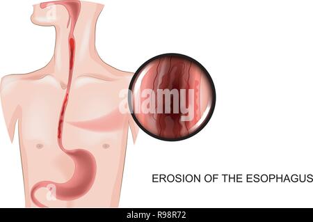 Vector Illustration der Erosion der Speiseröhre Stock Vektor