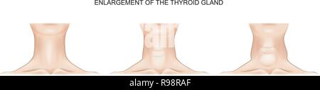Vector Illustration der Hals mit vergrößerten Schilddrüse Stock Vektor