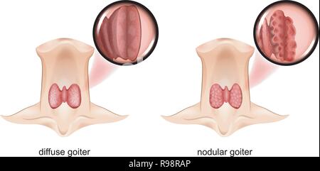 Vector Illustration von diffusen und Sphäroguss Kropf, die Schilddrüse ist ein Schnittbild Stock Vektor