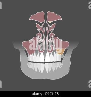 Flat Style. Odontogenic Sinusitis. Entzündung der Kieferhöhlen aufgrund einer Krankheit der Wurzeln der Zahn 10 eps Stock Vektor