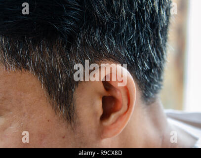 Weiße Haare verliert Haare in einem jungen Mann. Stockfoto