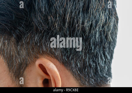 Weiße Haare verliert Haare in einem jungen Mann. Stockfoto