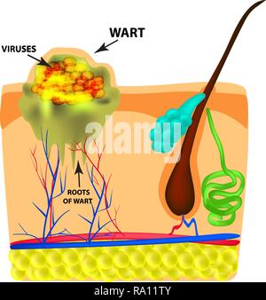 Die Struktur der Warze. Die Struktur der Haut. Infografiken. Vector Illustration auf isolierte Hintergrund Stock Vektor