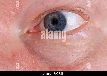 Wunde Trockene Haut und Augen auf dem Gesicht eines älteren Mannes. Studio makro Konzept geschossen Stockfoto