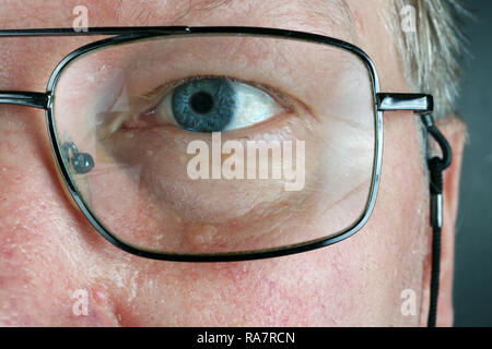 Wunde Trockene Haut und Blinden brillenbär Auge auf das Gesicht eines alten älterer Mann. Studio makro Konzept geschossen Stockfoto