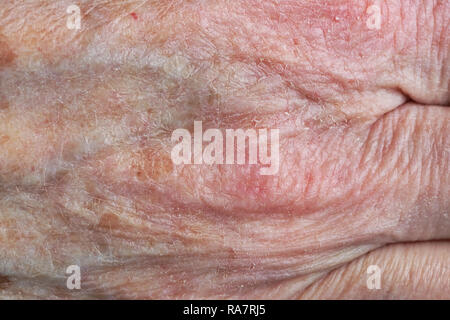Wunde Trockene Haut auf der Hand einer alten Frau Großmutter. Studio Makroaufnahme Stockfoto