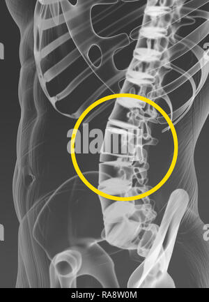 Vertebrale gemeinsame, Medizinisch 3D Artwork, x-ray anzeigen Stockfoto