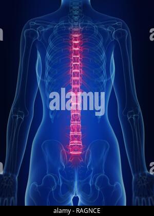 Abbildung: Rückseite schmerzhaft. Stockfoto