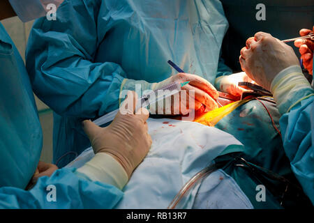 Der lunge Chirurg und team Thoraxchirurgie in Lungenkrebs durchführen Stockfoto