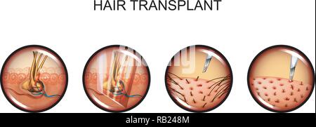 Vector Illustration der Haartransplantation. Kopf. Alopezie Stock Vektor