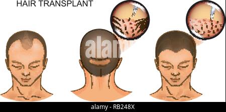 Vector Abbildung: Haar Transplantation des Okzipitalen Teil des Kopfes auf der frontalen Stock Vektor