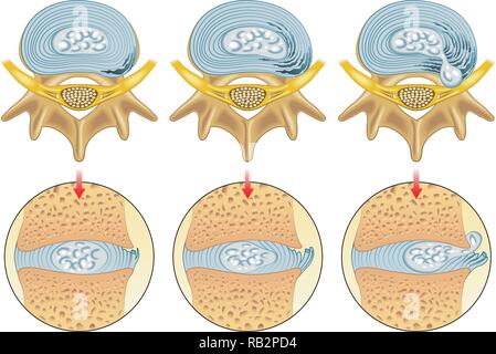 Medizinische Illustration der Auswirkungen von Bandscheibenvorfall Stock Vektor