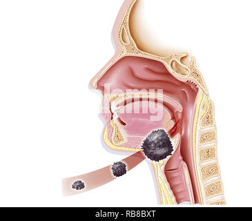Kehlkopfkrebs ABBILDUNG Stockfoto