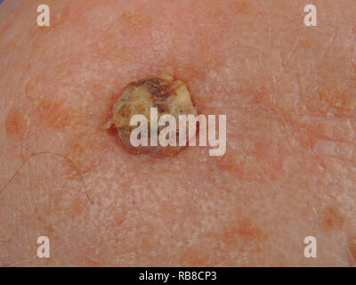 SQUAMOUS ZELLE KREBSGESCHWÜR Stockfoto