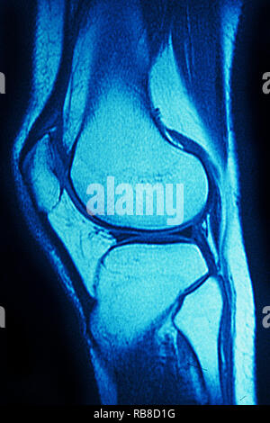 Mrt-normalen Knie Stockfoto