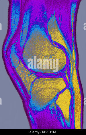 Normale Knie MRI Stockfoto