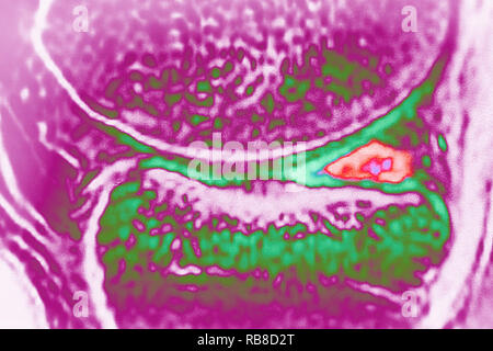 Beschädigten Meniskus horn Stockfoto