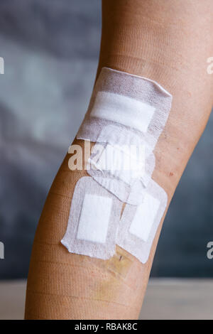 Bandagen od womans Bein nach Krampfadern Chirurgie. Eine kurative Behandlung, ästhetische Verfahren, Thrombose Verhütung und Senior Health Care Concept. Stockfoto