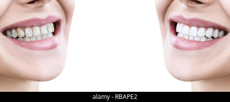 Zähne der jungen Frau vor und nach der Behandlung. Über weißen Hintergrund. Stockfoto