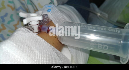 Ein Kind ist, um eine intravenöse Infusion vor einer Operation verbunden Stockfoto