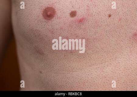 Gürtelrose, Herpes zoster, Blasen auf Körper, Varicella-zoster-Virus, Hautausschlag Stockfoto