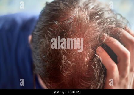 Kopfhaut der jungen kaukasischen Mann von oben gesehen und präsentiert ein Haarausfall Problem. Stockfoto