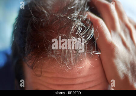 Kopfhaut der jungen kaukasischen Mann präsentiert ein Haarausfall Problem. Stockfoto