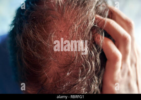 Kopfhaut der jungen kaukasischen Mann von oben gesehen und präsentiert ein Haarausfall Problem. Stockfoto