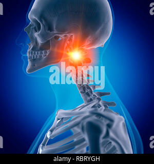 Abbildung: schmerzhafte Atlas Knochen. Stockfoto