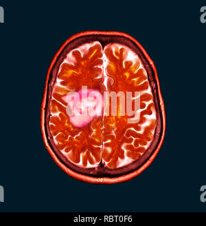 Glioblastom Gehirn Krebs. Farbige Computertomographie (CT) ein Schnitt durch das Gehirn eines 84-jährigen Patientin mit Glioblastom (dunklen Scans, links). Glioblastom, der aggressivsten Form des Hirntumors. Behandlung bezieht, Chirurgie, Chemotherapie und Strahlentherapie verwendet werden. Aber der Krebs in der Regel erneut auftritt, die trotz Behandlung und die häufigsten Dauer der Überlebenszeit nach der Diagnose ist 12-15 Monate. Ohne Behandlung, Überleben ist in der Regel 3 Monate. Stockfoto