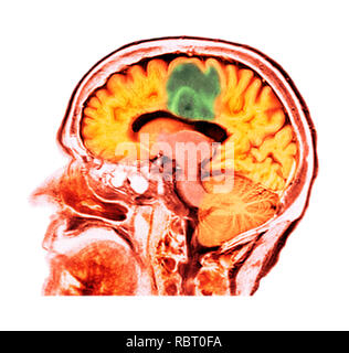 Glioblastom Gehirn Krebs. Farbige Computertomographie (CT), einen Abschnitt Scan durch das Gehirn eines 84-jährigen Patientin mit Glioblastom (dunkel, oben). Glioblastom, der aggressivsten Form des Hirntumors. Behandlung bezieht, Chirurgie, Chemotherapie und Strahlentherapie verwendet werden. Aber der Krebs in der Regel erneut auftritt, die trotz Behandlung und die häufigsten Dauer der Überlebenszeit nach der Diagnose ist 12-15 Monate. Ohne Behandlung, Überleben ist in der Regel 3 Monate. Stockfoto