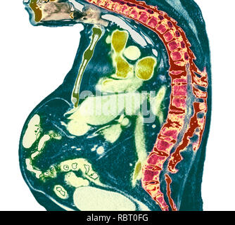 Wirbelsäule in ankylosing spondylitis. Farbige X-ray von einem Abschnitt durch die brustwirbelsäule eines 74-jährigen männlichen Patienten mit Morbus Bechterew, Sho Stockfoto