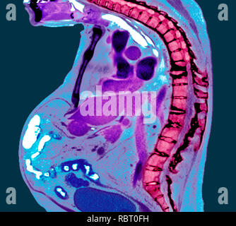Wirbelsäule in ankylosing spondylitis. Farbige X-ray von einem Abschnitt durch die brustwirbelsäule eines 74-jährigen männlichen Patienten mit Morbus Bechterew, Sho Stockfoto